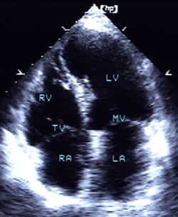 RV - Right Ventricle, TV - Tricuspid Valve, RA - Right Atrium, LV - Left Ventricle, MV - Mitral Valve, LA - Left Atrium