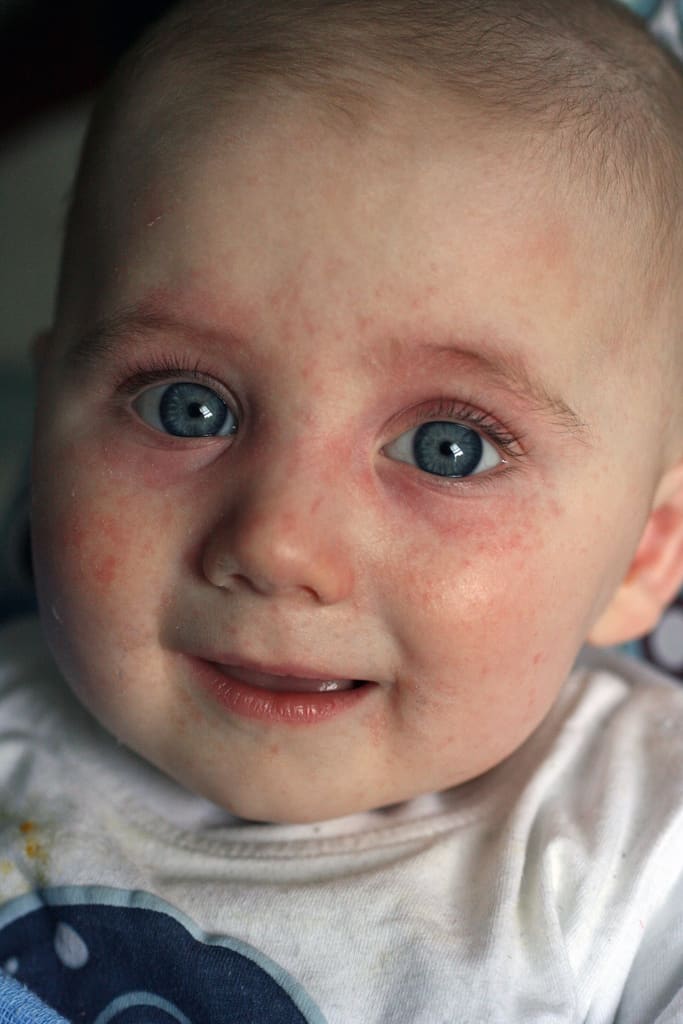 Food allergies can cause a number of reactions - find out what the most common food allergies are, how to treat them and how to avoid a reaction.