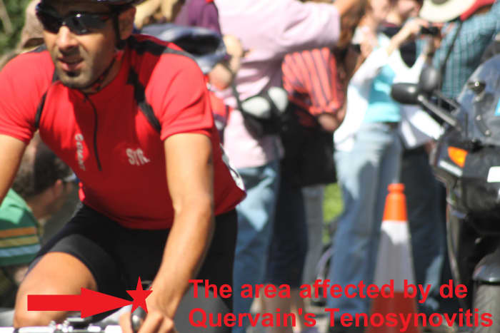 De Quervain's Tenosynovitis affects the area between thumb and forearm (as starred)
