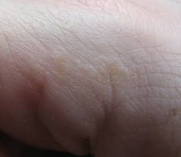 This is a photograph of my own pompholyx on my hand after optimising my immune system but without introducing iodine.