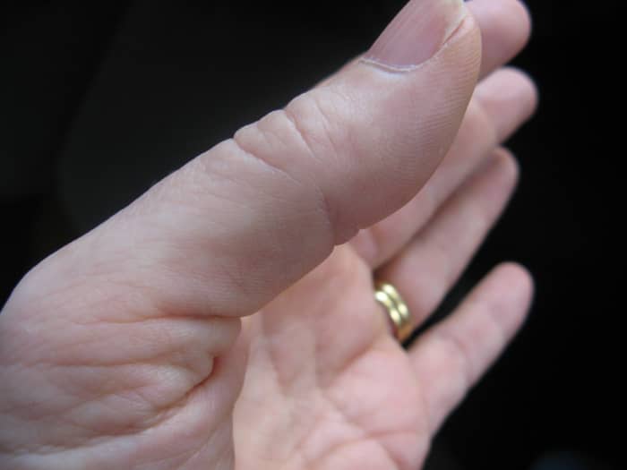 This is a photograph of my hand after optimising my immune system and introducing iodine. My feet and my hand skin is clear once again.
