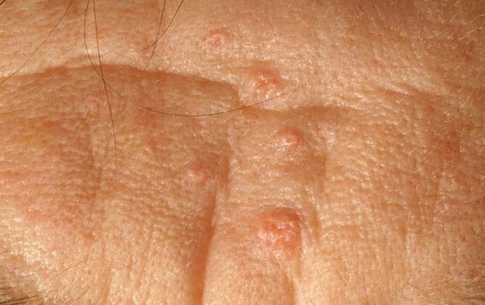 Sebaceous Glands Pictures Function Types Location Hubpages