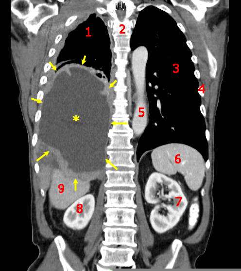 Malignant Mesothelioma, coronal CT scan. Legend: the malignant mesothelioma is indicated by yellow arrows, the central pleural effusion is marked with a yellow star. (1) right lung, (2) spine, (3) left lung, (4) ribs, (5) aorta, (6) spleen, (7) left