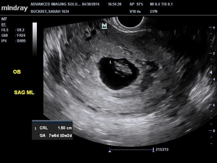 The empty sac on the right side indicates a twin that didn't make it past the embryonic stage. See the blood in the lower half of the sac.