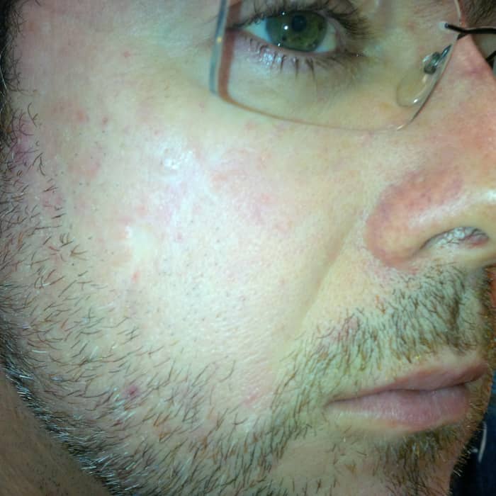 Here we are a year on. there is no doubt that continued use with reduce a scar to barely visible