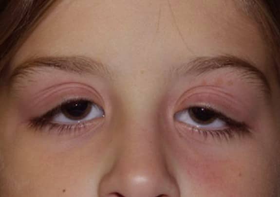 swollen-eyelid-symptoms-treatment-pictures-causes-hubpages