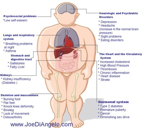 Anatomical clip art figure of an obese man detailing the various diseases that weight and inactivity can cause to the human body