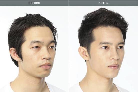 Before and after plastic surgery Notice the widening of the eyes, the straightening of the nose and the reduction of the cheeks.
