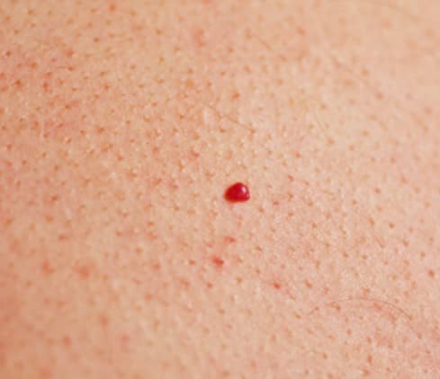 Cherry Angiomas - Pictures, Symptoms, Causes, Treatment, Removal - HubPages