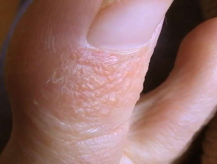 Pompholyx Pictures, Symptoms, Treatment, Diagnosis, Causes, Cure