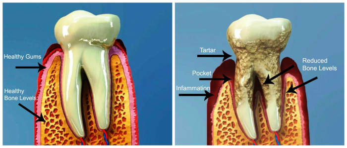 Healthy tooth with healthy gum and bone levels compared with moderate periodontitis. Teeth begin to loosen as the bone levels erode.