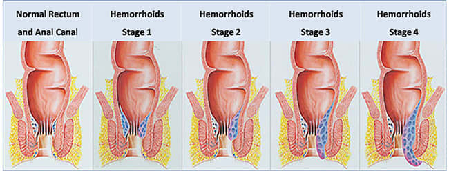 case study on hemorrhoids slideshare
