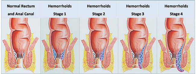 how-i-cured-my-horrendous-hemorrhoids-in-2-weeks-hubpages