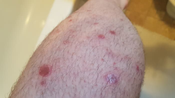 Psoriasis spots all down my leg. They get worse in the winter, when skin is covered from the sunlight.