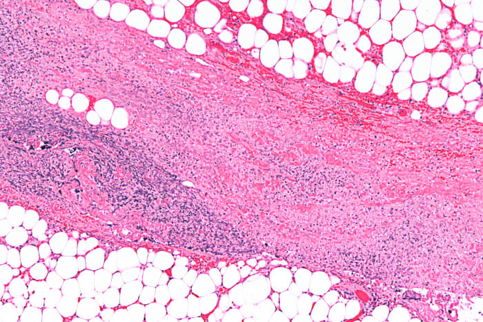 In this example of necrotizing fasciitis, the tissue in the middle has undergone necrosis (tissue death). This is why the cells are no longer visible.