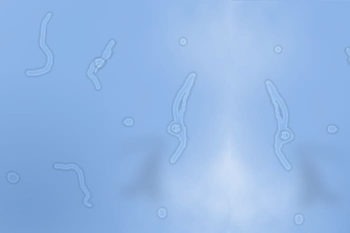 When the vitreous detaches, loose cells float around and look like thread-like strands. We call these "floaters."