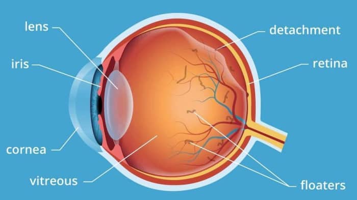 A Posterior Vitreous Detachment occurs as the vitreous shrinks and pulls away from the rear of the eye.