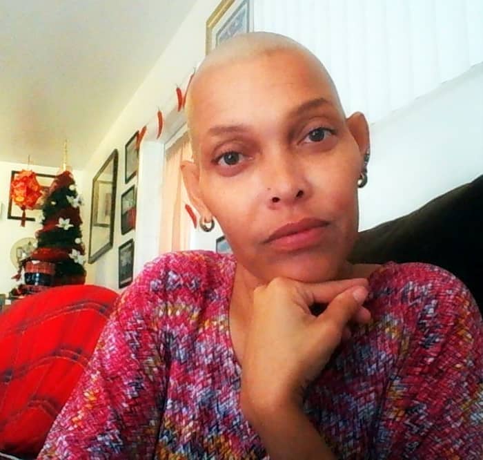Find out how your scalp looks, how scalps can get sunburned, how beautiful your face looks without hair.
