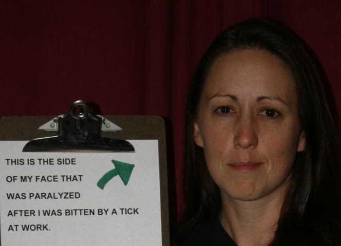 This is me after Bell's palsy. Some people never regain movement of the paralyzed side or can take many years to do so.