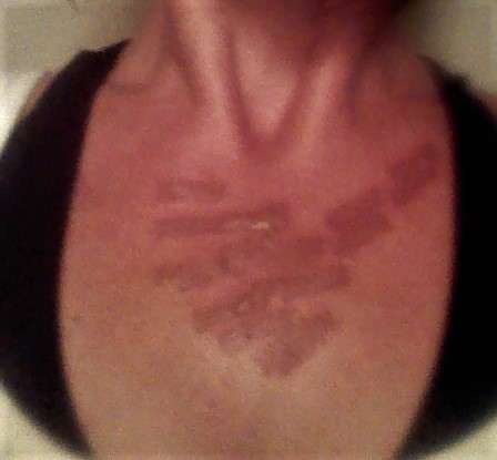 Two Days Post Treatment