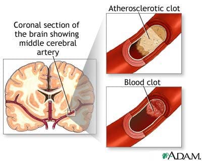 Cerebral Artery with healthy and plaque artery pictures courtesy of http://health.allrefer.com/health/stroke-pictures-images.html