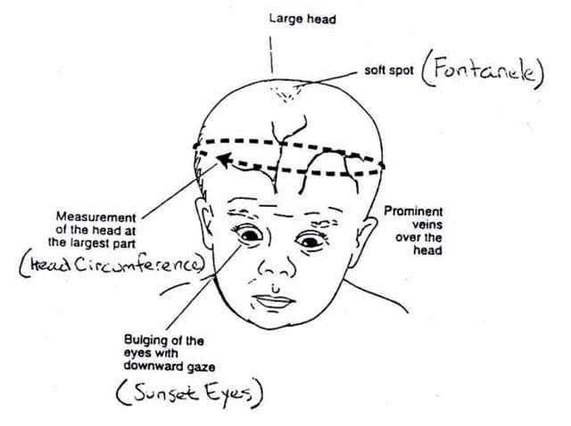 Hydrocephalus in Pediatrics - HubPages