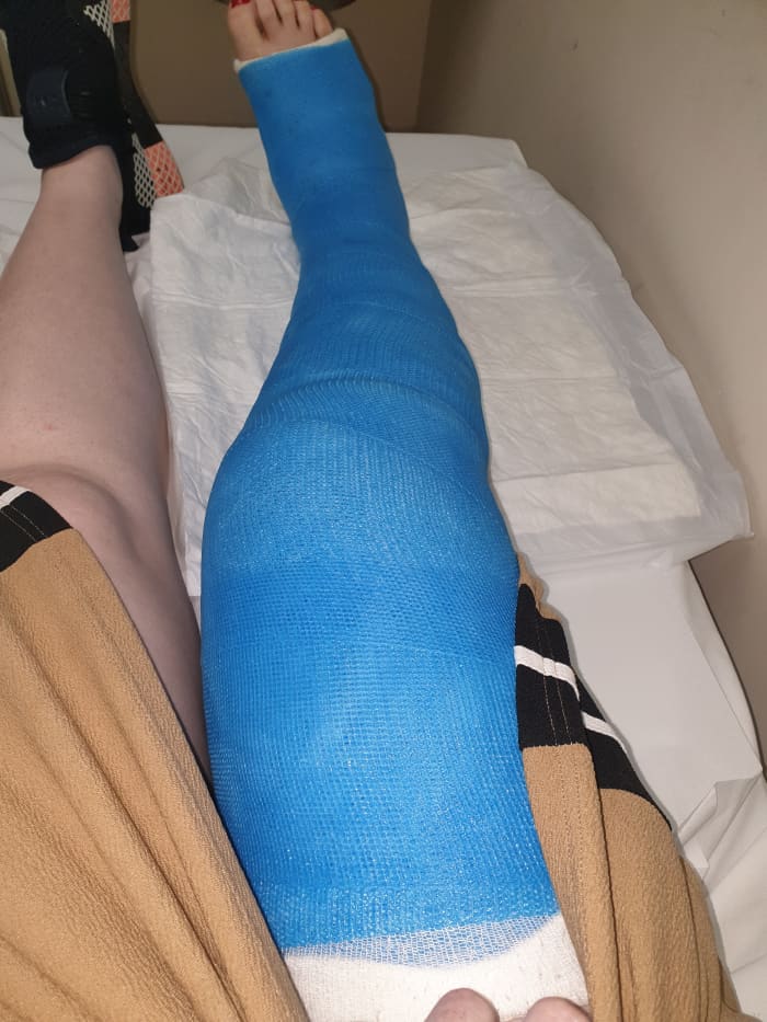 A picture of my leg with my fiber glass full leg cast. Note, this was not intended for walking around on and was none weight bearing.