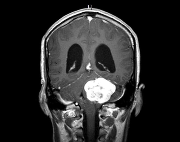 My husband's brain tumor, a benign but large, acoustic neuroma, was removed during a 14-hour surgery on Halloween Day. This day will always be surreal to me, and this emotional account concludes the story of my husband's surgery.