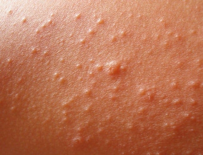 Heat Rash Pictures Symptoms Causes Treatment Home Remedies 