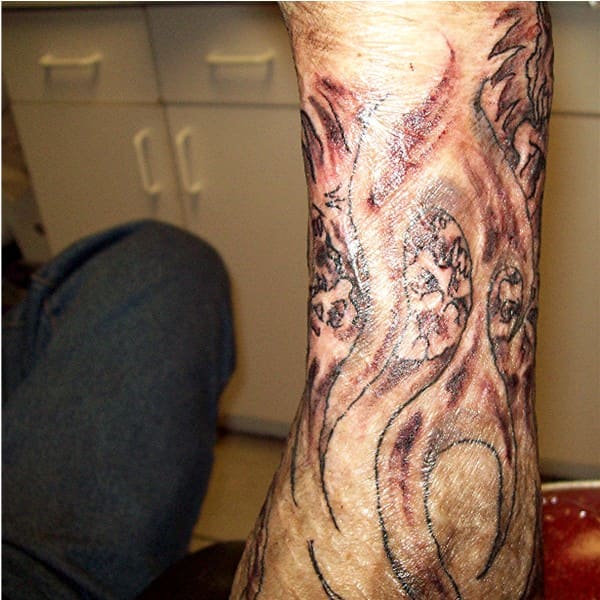 Tattoos on Burned, Scarred, or Grafted Skin - HubPages