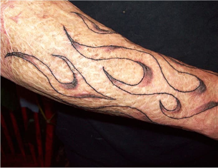 Scott's tattoo one day after the first visit. His grafted skin bruised from the shading, but not the outline.