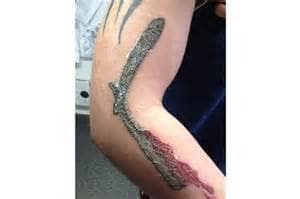 Scabbing on a tattoo. It appears the skin is having a major reaction to the ink used. This tattoo will in all likeliness have substantial damage.