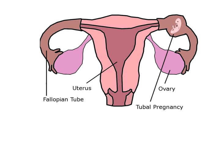 When an embryo implants in the Fallopian tube, the pregnancy is not viable and threatens the life of the mother.