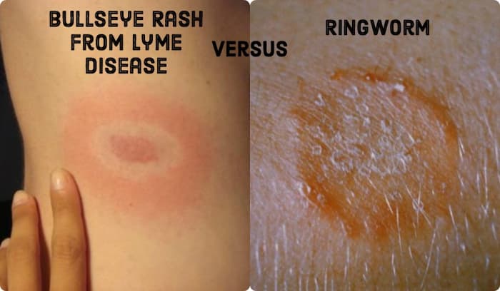 Ringworm and Lyme disease cause very similar rashes with a few key differences.
