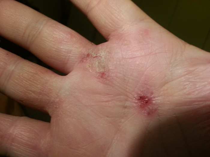 Domeboro Soaks for Treatment of Allergic Eczema and Contact Dermatitis Patient's Lounge