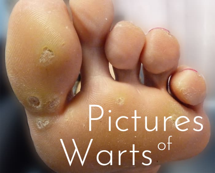 Plantar Warts or Verrucas on Foot.