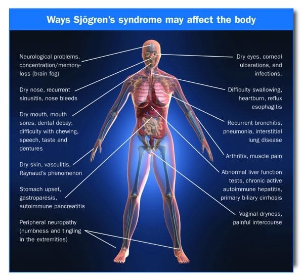 Sjogren's Syndrome. My Experience - HubPages