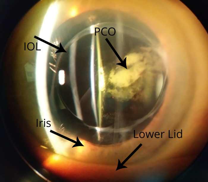Definition of YAG Laser Posterior Capsulotomy HealthProAdvice
