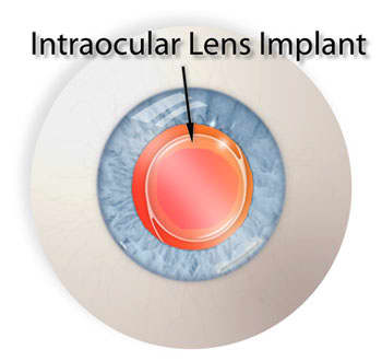 Needing and Getting Cataract Surgery and Lens Implants - HubPages