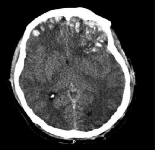 Facts of Traumatic Brain Injury - HubPages