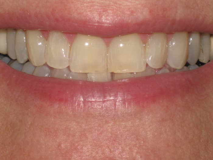 Wow I was even more amazed at the results by Day 5, decided to go the whole 7 days