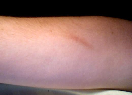 There are a few products and techniques that can lighten dark scars like this one.