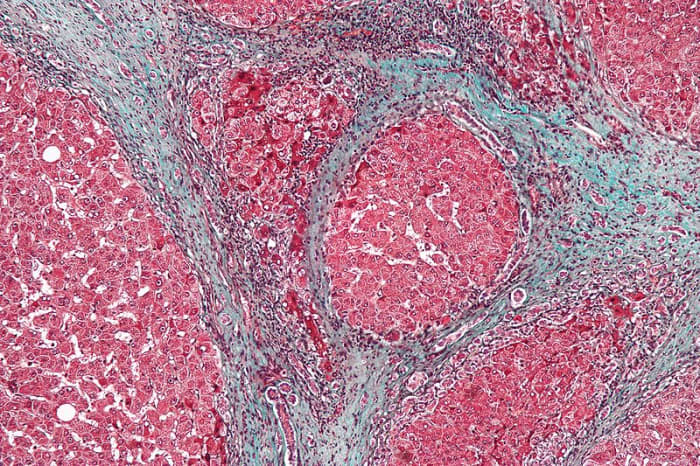 Micrograph showing cirrhosis. Trichrome stain. source Wikipedia - Which is better for you? Beer or Red Wine