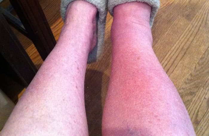 In this photo you can see the difference in size between my left and right legs due to RSD.