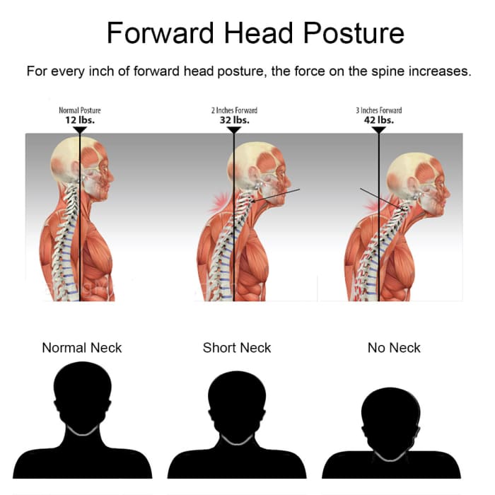 Overcoming Stiff Neck and Headaches With Passive Stretching and Gravity ...