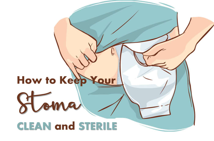 Taking Care Of Your Stoma After An Ostomy Patients Lounge 2631