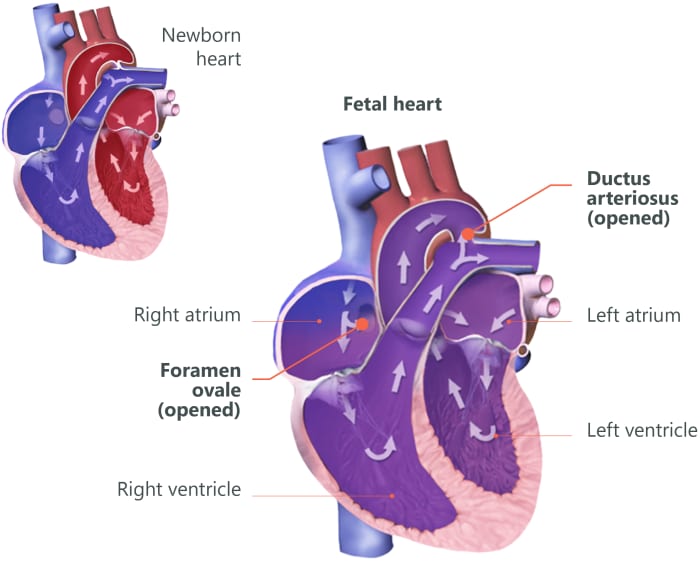 Patent Ductus Arteriosus : Pediatric Heart Defect - HubPages