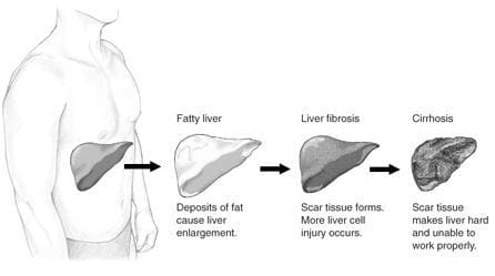 Stages of liver damage