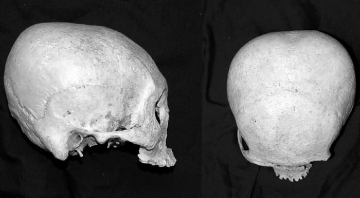 The Precolonial Visayan Practice of Skull Deformation - HubPages