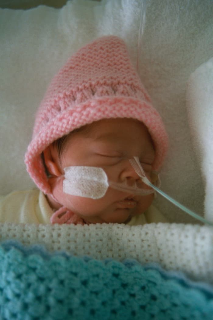 This baby receives oxygen through nasal prongs taped to her face. On admittance to hospital it is more likely a mask will be used instead.